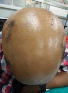 Alopecia totalis 